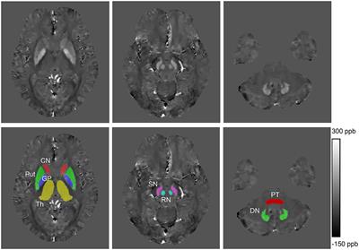 Increased Magnetic Susceptibility in the Deep Gray Matter Nuclei of Wilson's Disease: Have We Been Ignoring Atrophy?